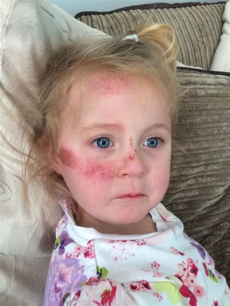 Toddler Injured Cheek