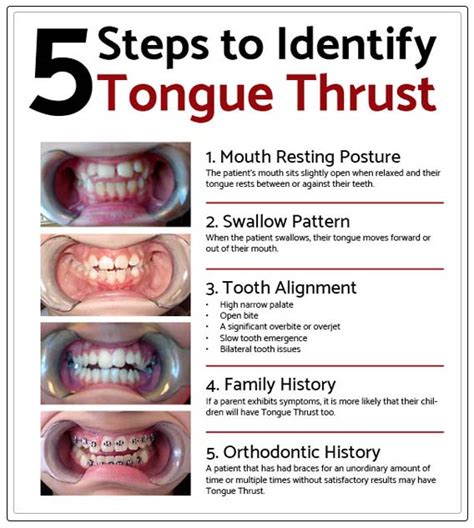 Tongue Thrust in Children and Adults