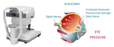 Tonometry: The Glaucoma Check