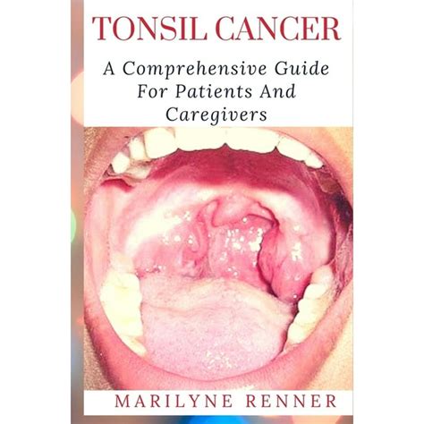 Tonsil Cancer Image