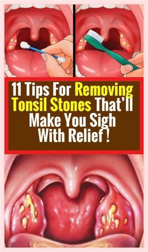 Tonsil Stones: Quick & Easy Removal Tips