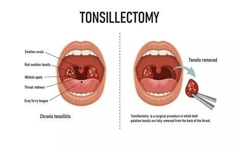 Tonsil Surgery: Recovery, Risks & Relief