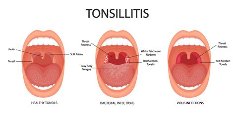 Tonsil Troubles: Avoid These Common Mistakes