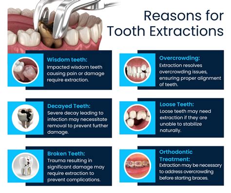 Tooth Extraction: Reasons, Risks & Recovery Tips.