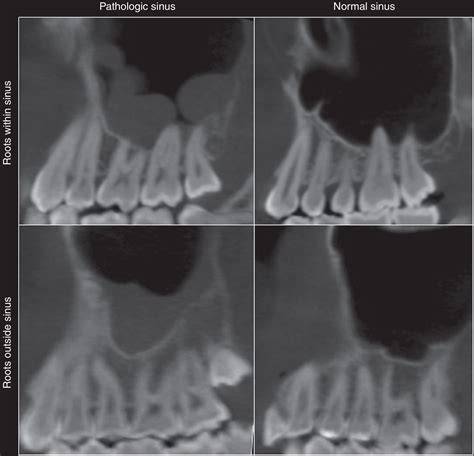 Tooth Root In Maxillary Sinus Symptoms