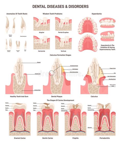 Tooth Roots: Function, Disorders & Solutions