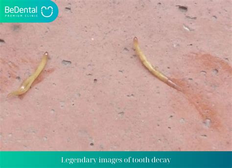 Tooth Worms & Cavities: Fact or Fiction?