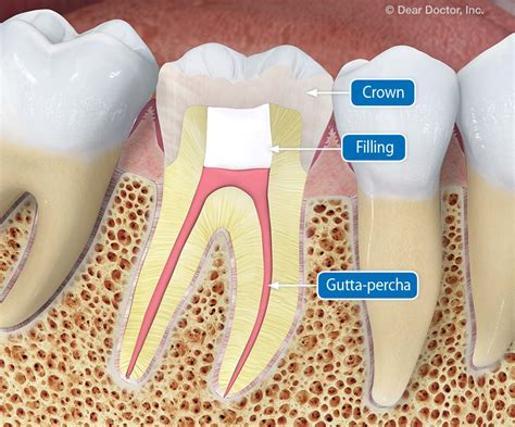 Tooth-Root-Canal-And-Crown-Image