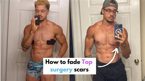 Top Surgery Healing Time