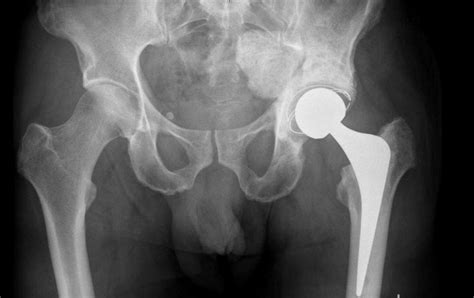 Total Hip Replacement (THR)