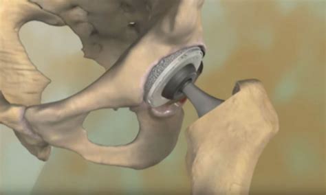 Explore Total Hip Replacement with Our Comprehensive Video Animation Guide