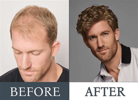 Toupees and Systems: Specific Coverage for Men