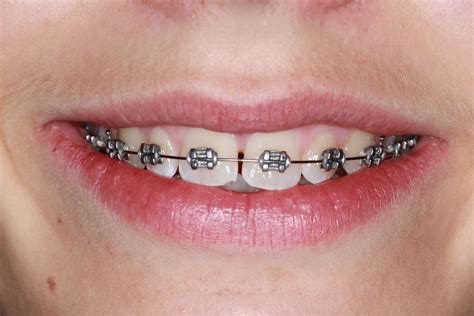 Traditional Metal Braces