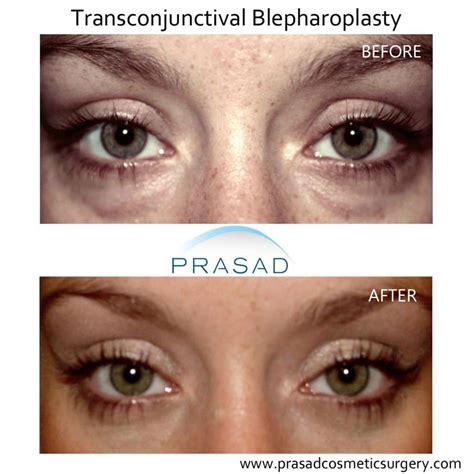 Transconjunctival Blepharoplasty (Internal Incision)