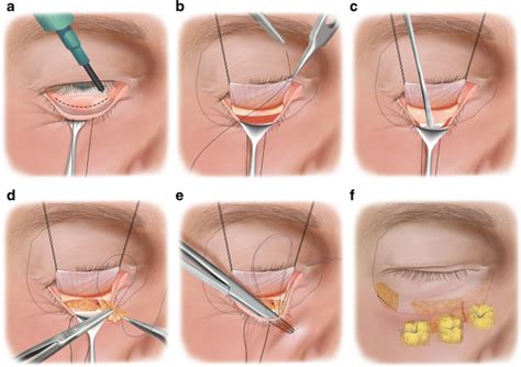 Transcutaneous Approach (Skin Incision)