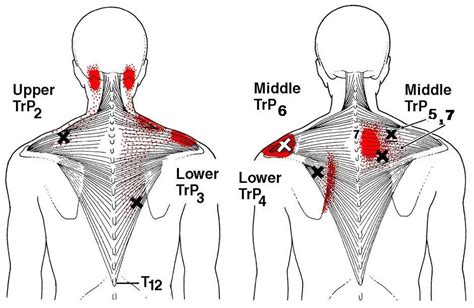 The Unbearable Suffering of Chronic Trapezius Pain: Tips and Remedies to Relieve Months of Agony
