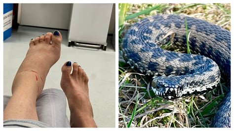 Treating an Adder Bite