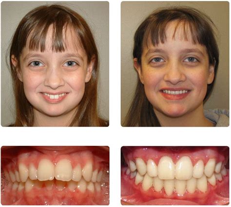 Treatment Options for Overbite