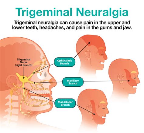 Trigeminal Neuralgia Pain Chart