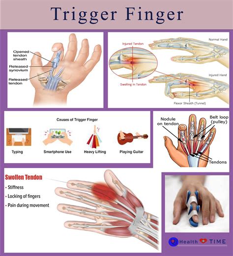 Trigger Finger: Causes & Effective Treatments