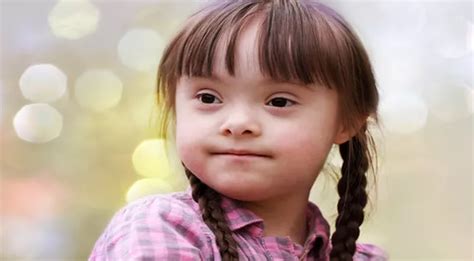 Trisomy 21 Salah Satu Penyebab Sindroma Down Pada Anak