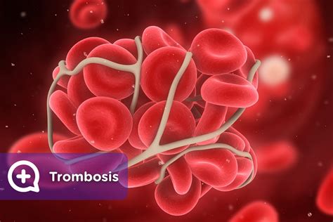 Trombosis