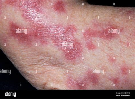 The Skincare Enigma: Discover the Astonishing Tuberculosis Skin Rash Pictures