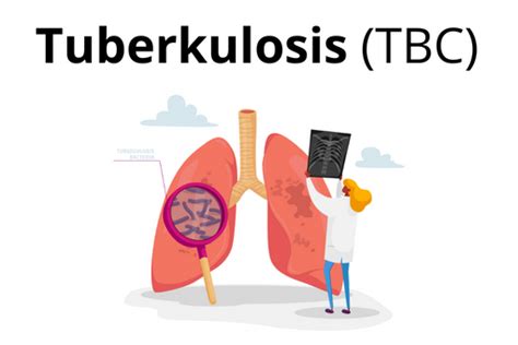Tuberkulosis