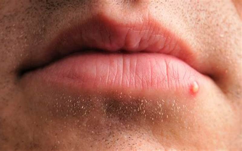 Tumbuh Jerawat Di Bibir: Apa Yang Harus Dilakukan?