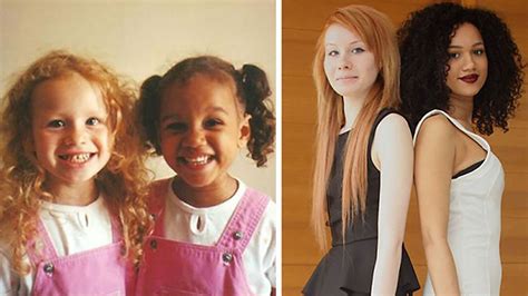 The Heartbreaking Story of Twins Born with Opposite Skin Colors