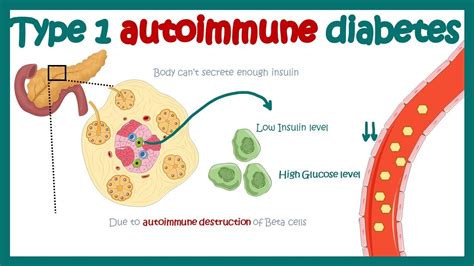 Type 1 Diabetes The Autoimmune Factor
