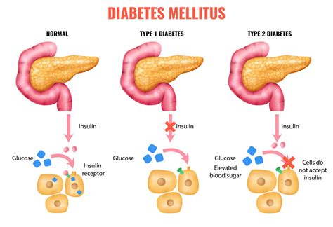 Type 2 Diabetes: Gradual Development