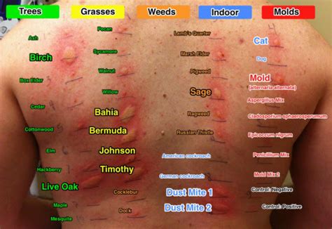 Type of Allergy Test