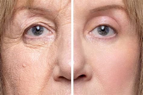 Type of Blepharoplasty