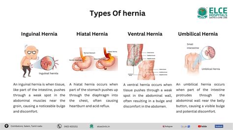 Type of Hernia