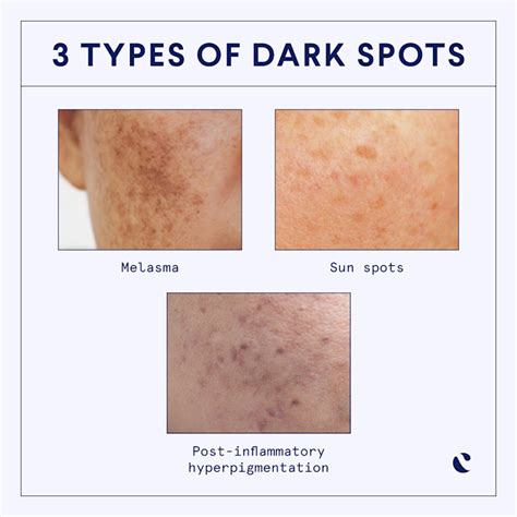 Types d'hyperpigmentation