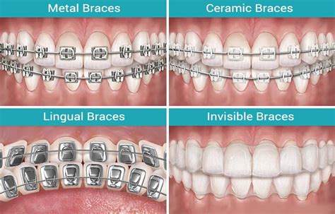 Types of Braces