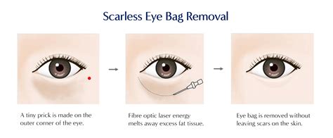 Types of Eye Bag Treatment Laser Technology