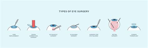Types of Eye Cat Surgery Procedures