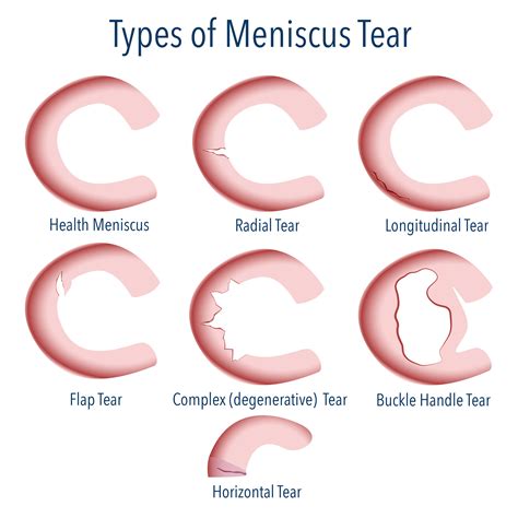 Types of Meniscus Tears
