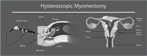 Types of Myomectomy Procedures