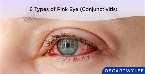 Types of Pink Eye