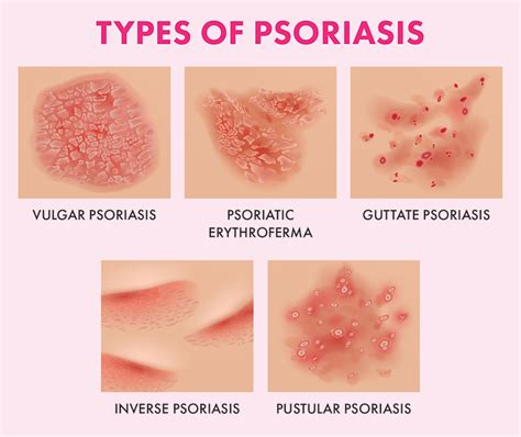 Types of Psoriasis Pictures: Visual Guide