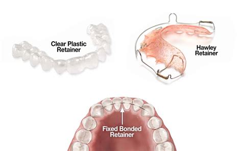 Types of Retainers