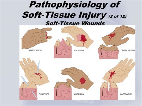 Types of Soft Tissue Damage