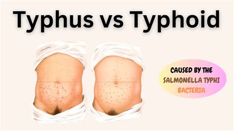 Typhus vs. Typhoid: Know the Key Differences