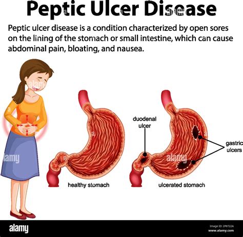 Ulcer