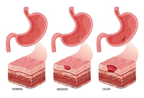 Ulcerations In Stomach