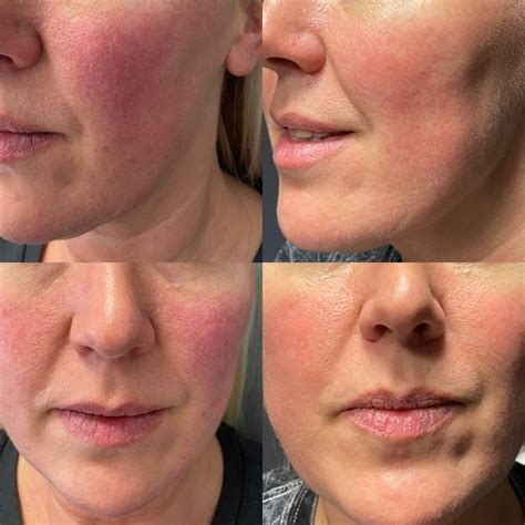 Uncover the Truth: Derma Stamp Reviews - A Comprehensive Analysis