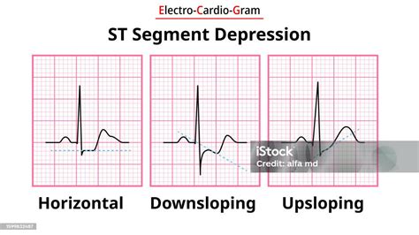 Understanding 0.5 mm Upsloping ST Depression